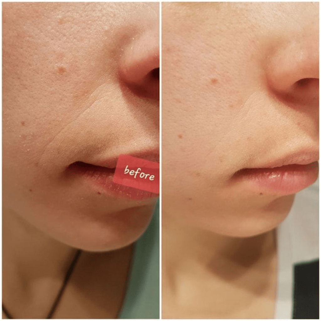 Avant après utilisation soins visage naturels amélioration texture de peau réduction pores et imperfections